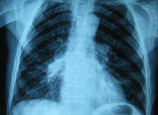 Chest x-ray