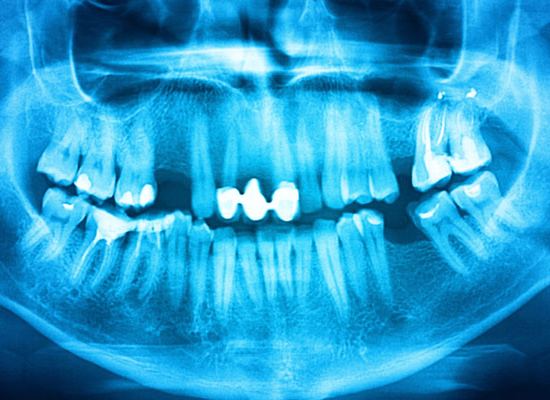 Panoramic dental x-ray