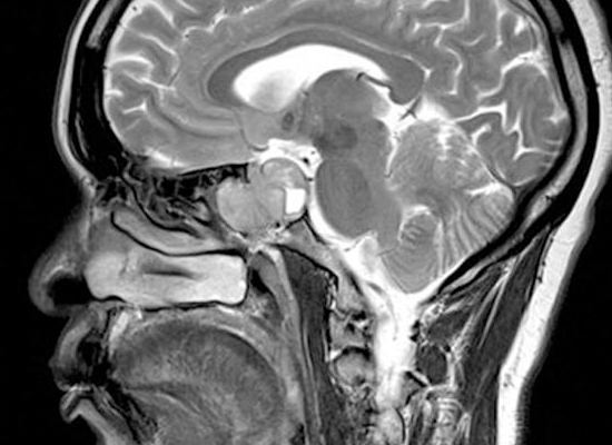 Head MRI scan